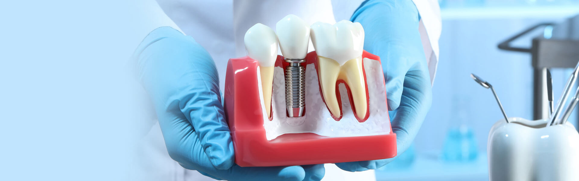 How Long Does It Take To Recover From A Dental Implant?
