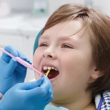 Say Goodbye to Tooth Sensitivity with Fluoride Treatments